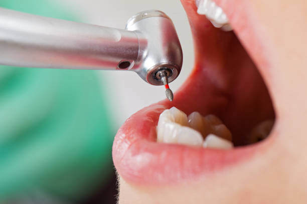 Best Emergency Broken Tooth Repair in Byram, CT